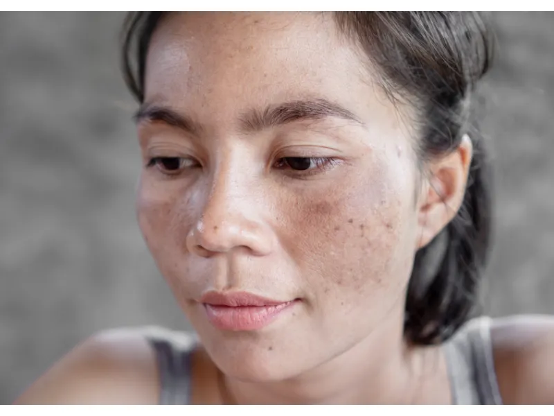 young woman with melasma